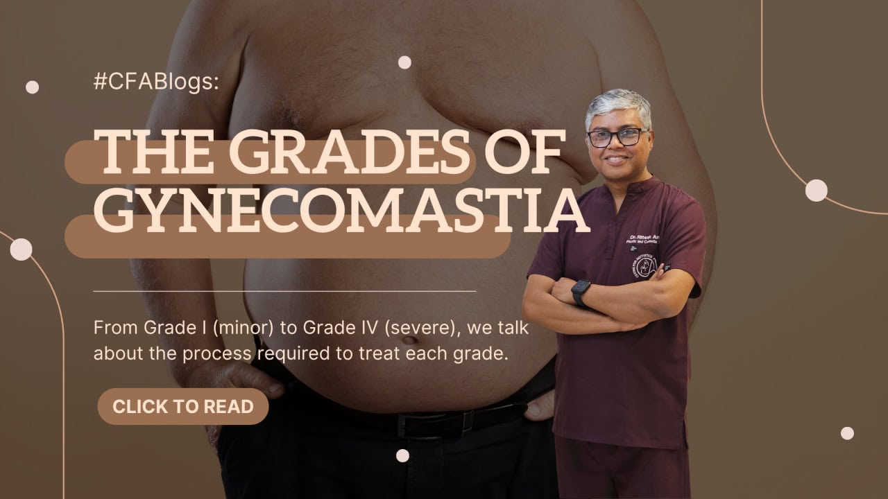 All About The Grades of Gynecomastia