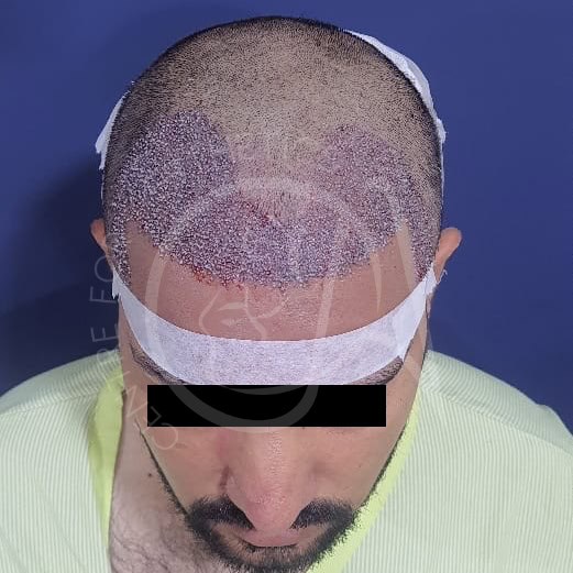 Patient's scalp immediately after hair transplant surgery showing freshly implanted grafts