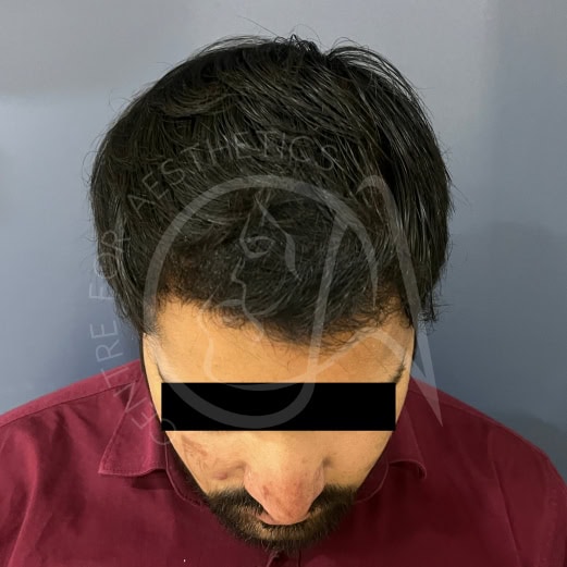 Density building 5 months after hair transplant