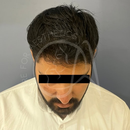 Hair transplant results at 6 months showing noticeable density improvement