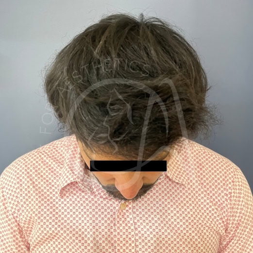 Final hair transplant result at 12 months showing full natural density and seamless hairline